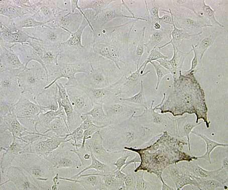 hautkrebs1.jpg hautkrebs1.jpg